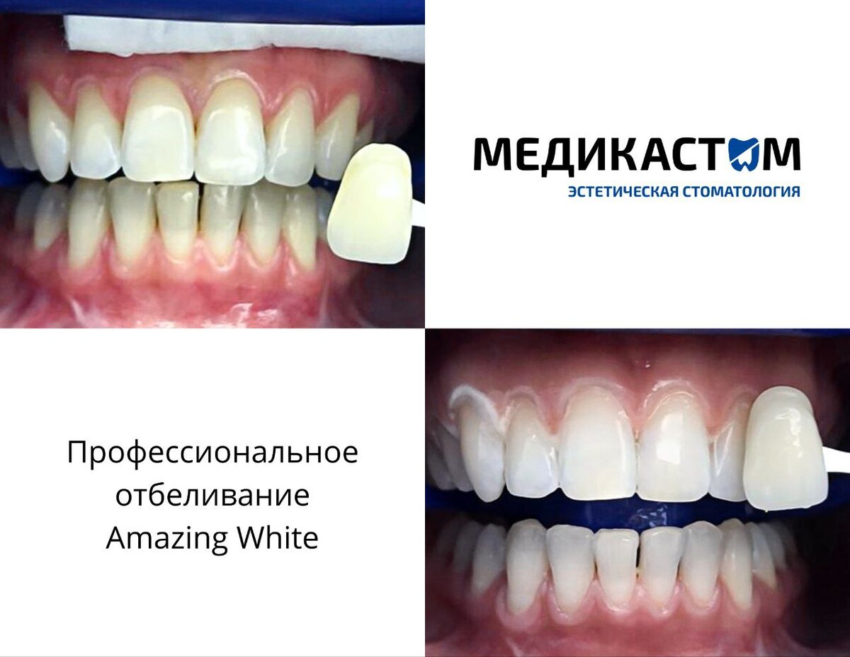 Врач поможет выбрать оптимальный метод отбеливания и, при необходимости, провести санацию полости рта и подготовить вас к данной процедуре.