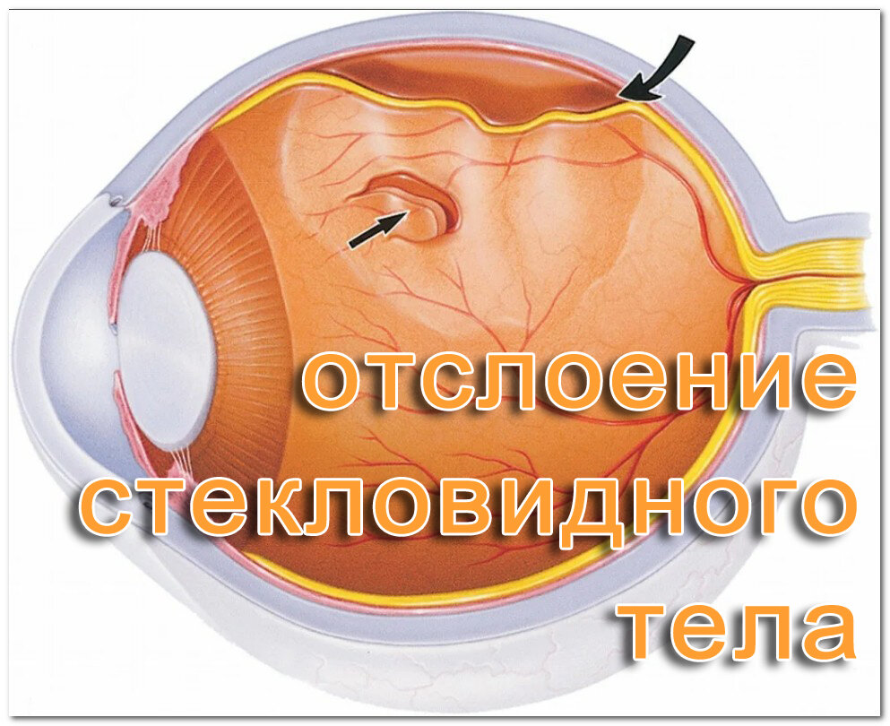 Отслоение стекловидного тела