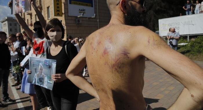 вышедший из минского СИЗО мужчина показывает побои