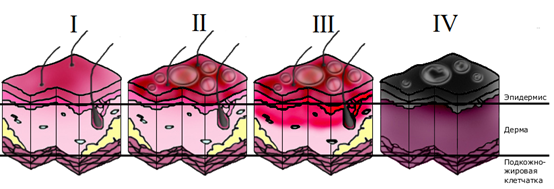 Рис. 1. Классификация степеней термических ожогов