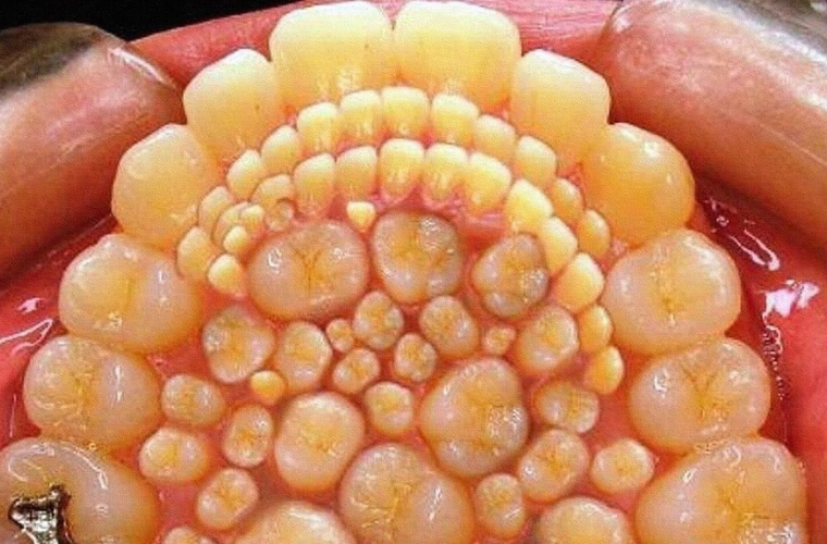 Так выглядели во рту 232 зуба (источник фото https://s30243127481.mirtesen.ru/blog/43876881701/232)