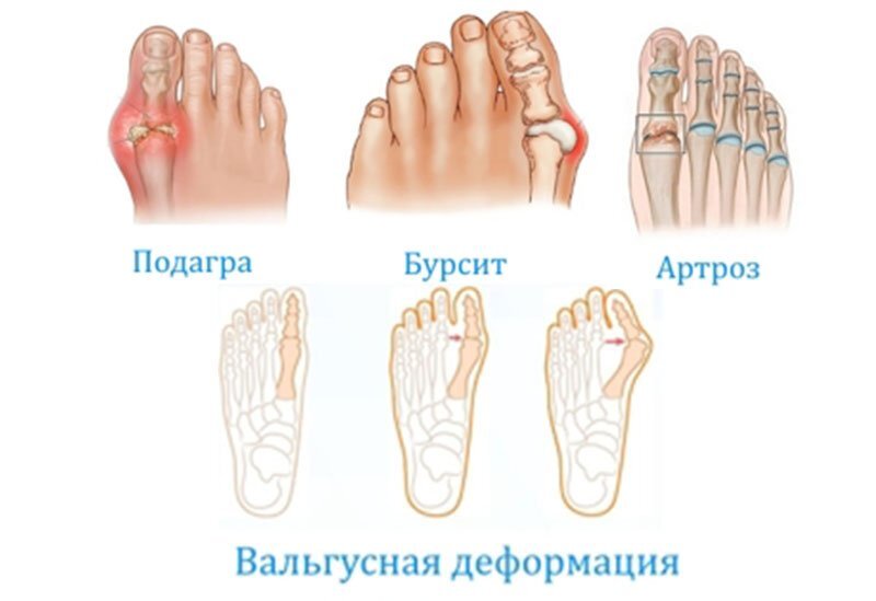 Боль в суставе большого пальца ноги: внутренние причины
