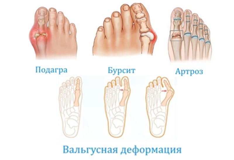 Вальгусная деформация стопы - причины, последствия, лечение