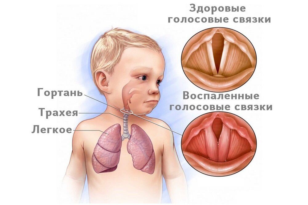 Презентация круп у детей