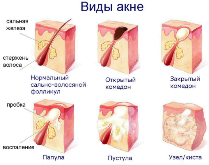 Как навсегда избавиться от прыщей на спине: домашний уход и салонные процедуры