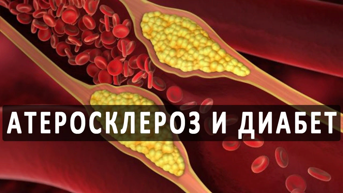 Диабетический атеросклероз. Атеросклероз и сахарный диабет. сахарный диабет и атеросклероз связь. сахарный диабет бляшки.
