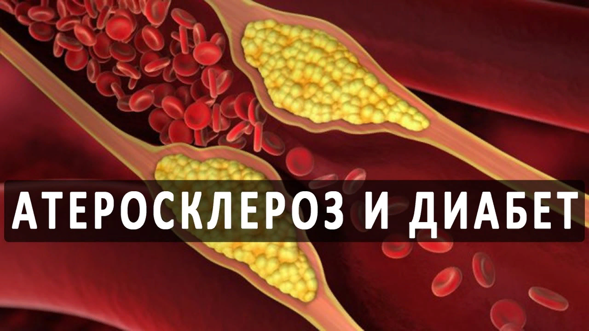 Атеросклероз при диабете. Атеросклероз при сахарном диабете. Атеросклероз и сахарный диабет. Сахарный диабет и атеросклероз связь.