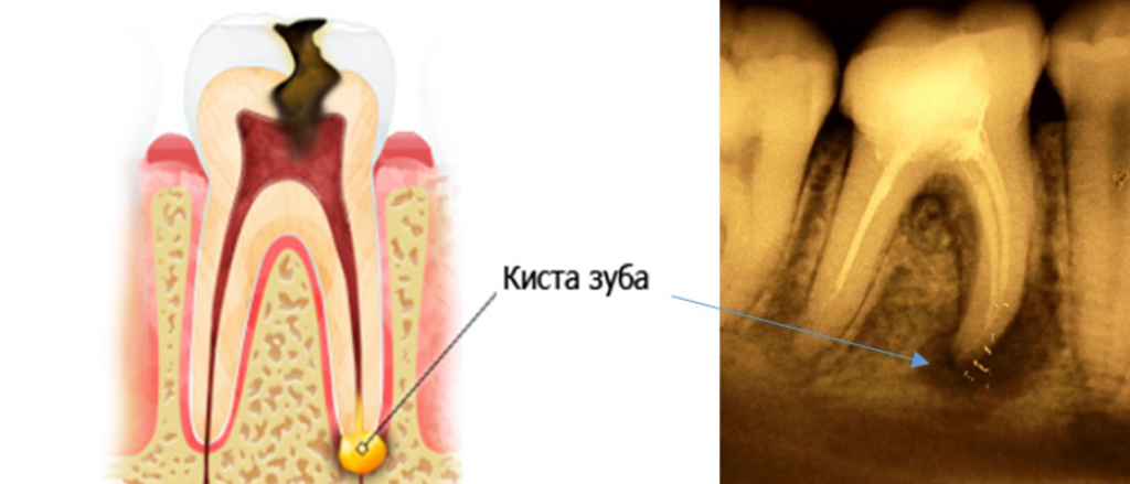Температура после лечения зуба. Периодонтальный абсцесс. Межкорневая гранулема. Периодонтит свищевой ход хронический.