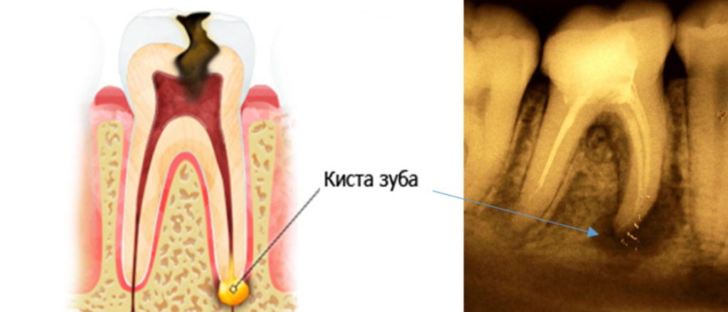 На корне зуба. Периодонтальный абсцесс. Межкорневая гранулема. Периодонтит свищевой ход хронический.