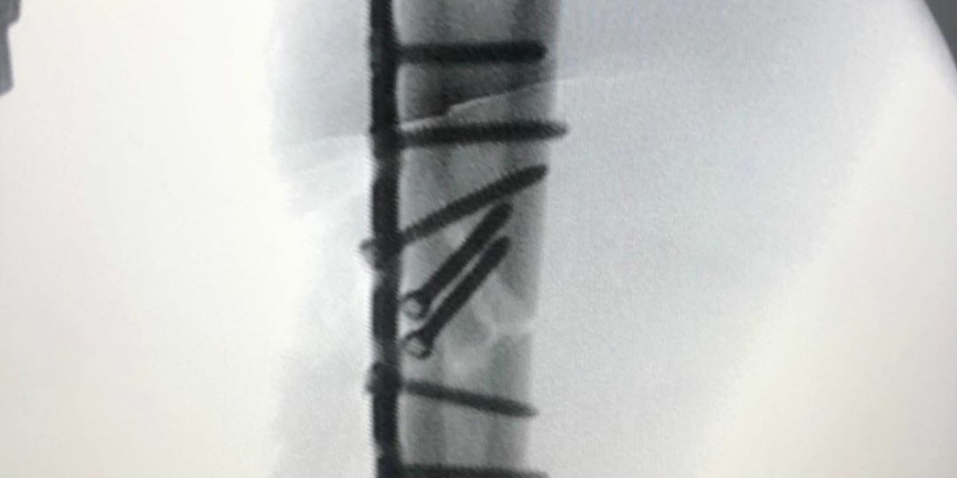 Цена героизма или почему не стоит через три дня после операции гонять на мотоцикле