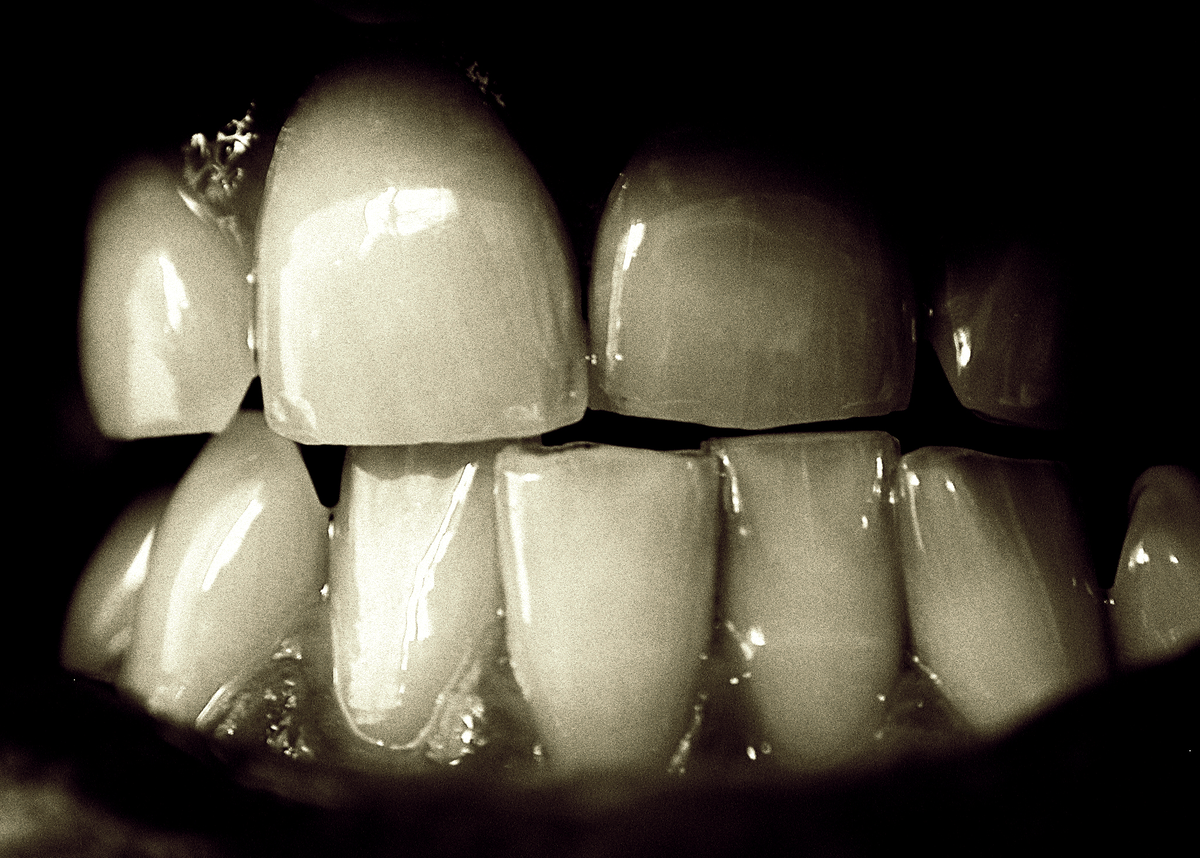 Бруксизм или скрип зубами во сне: причины, диагностика и лечение