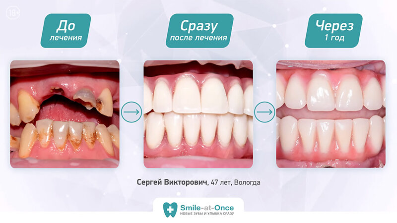 Решить проблему оказалось проще и быстрее, чем представлял пациент – с помощью комплексной имплантации зубы восстановили буквально за 3 дня