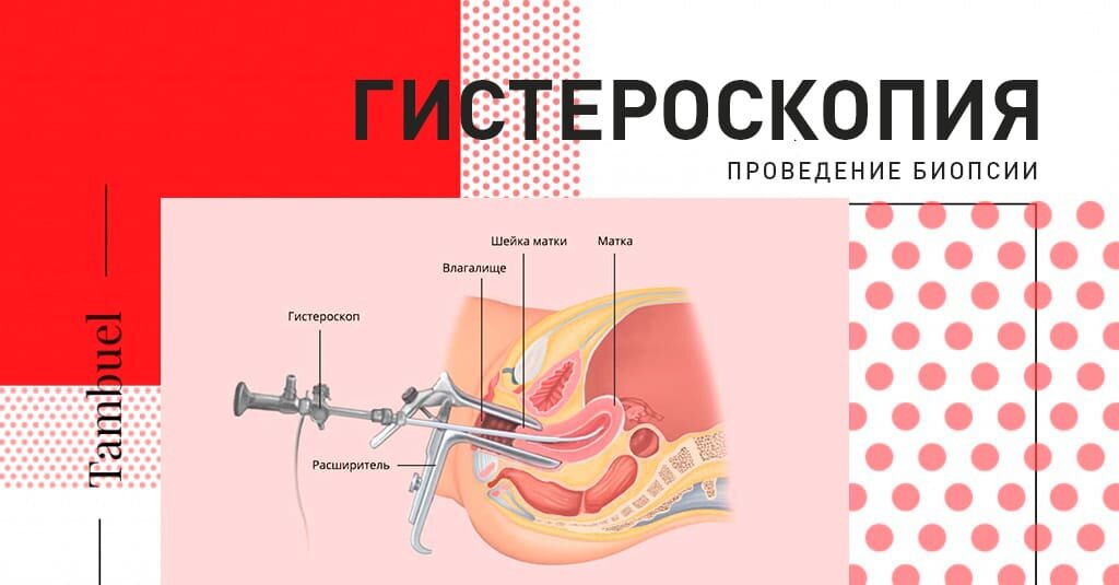 Что такое процедура кольпоскопия в гинекологии