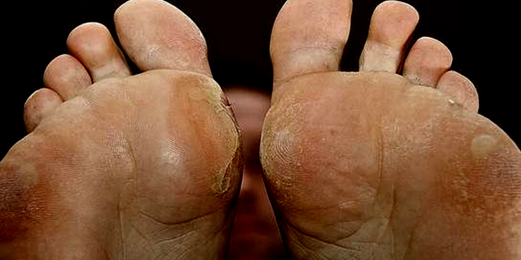 Сухие мозоли. При хорошем уходе, увлажнении и питании стоп, они проходят.