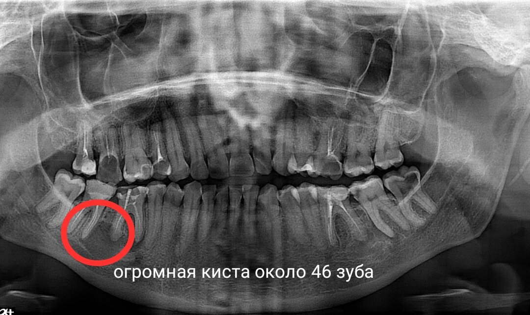 Та самая ортопантограмма, с которой всё и началось