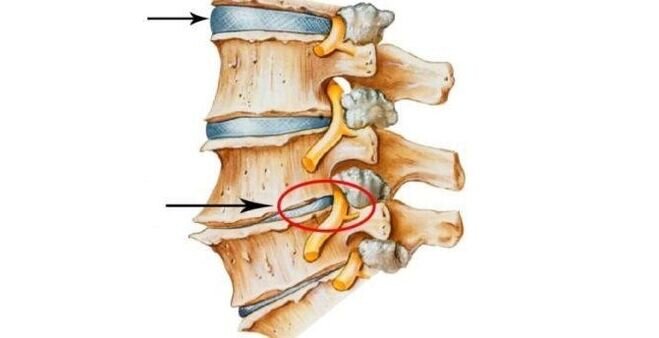 Лечение поясничного остеохондроза