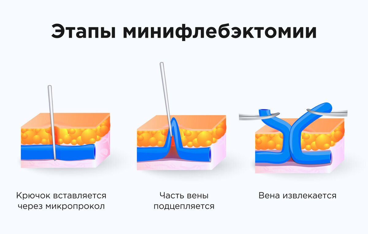 Этапы минифлебэктомии