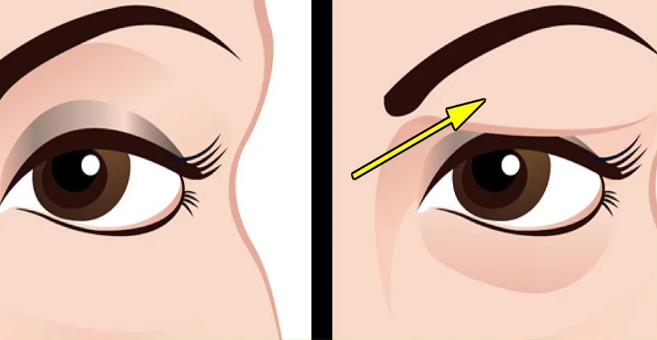 Птоз верхнего века: симптомы и лечение опущенного века в Химках