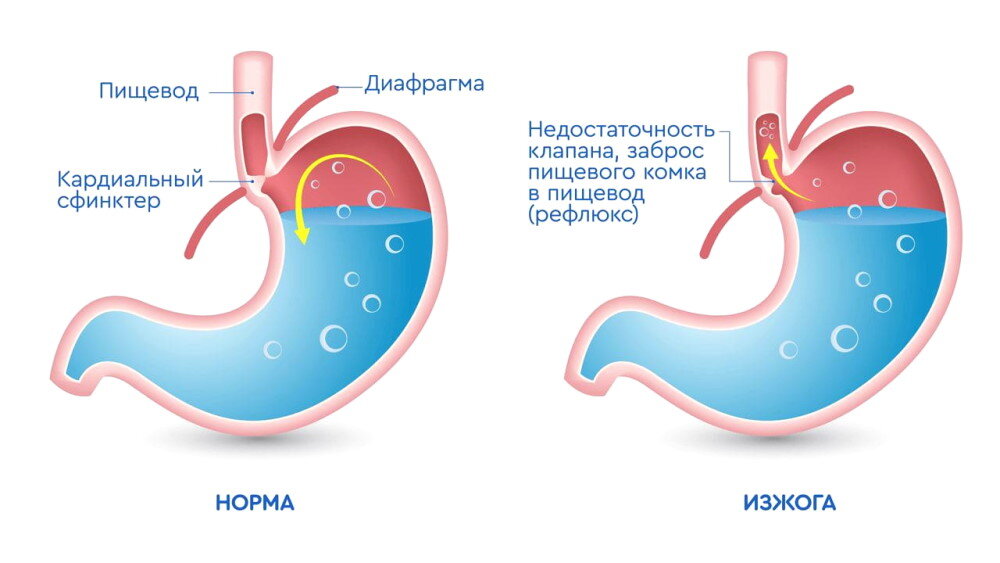 Изжога в горле причины