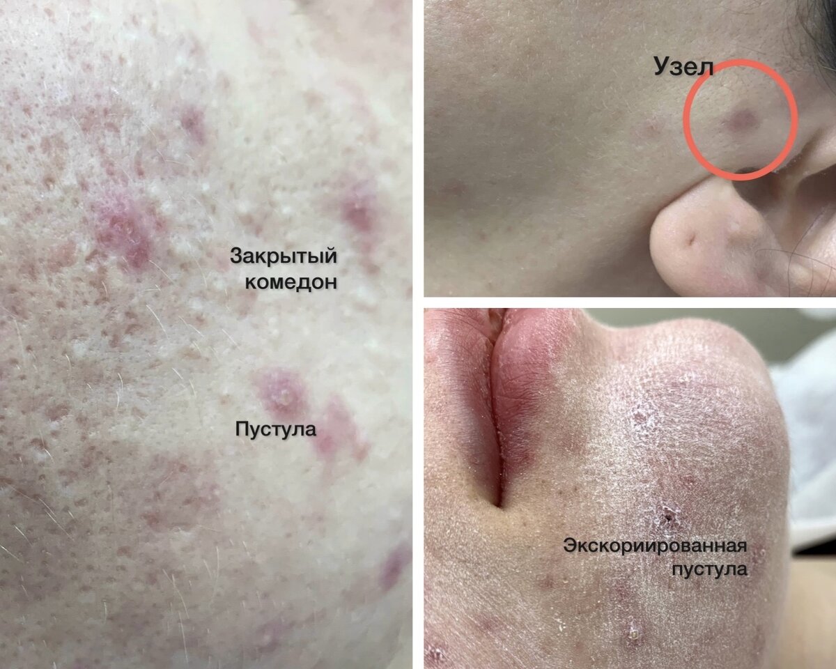 Чистка лица. Косметолог Мария Емельянова. 