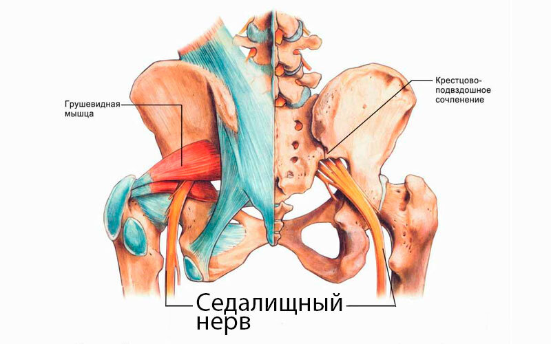 Защемление седалищного нерва симптомы и лечение