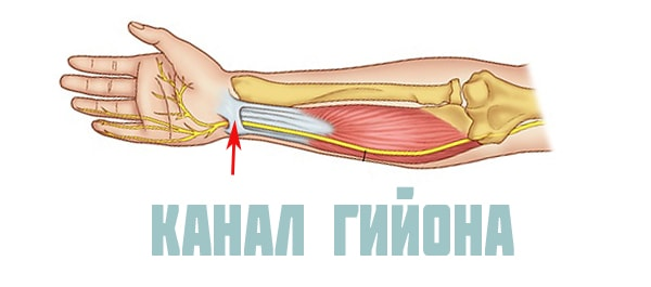 Синдром запястного канала: когда немеют пальцы на руке