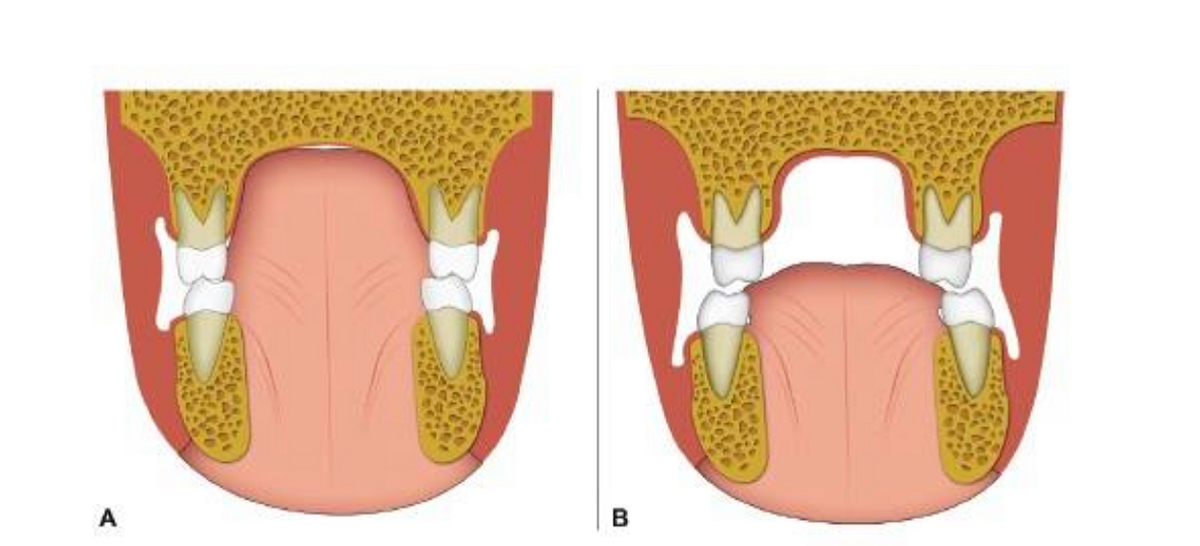правильное положение языка. правильная позиция языка. неправильное положение языка. позиция языка. позиция языка.