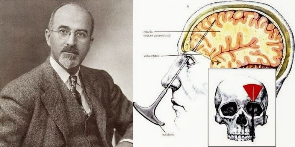 Префронтальная Лоботомия. Лоботомия Уолтер.
