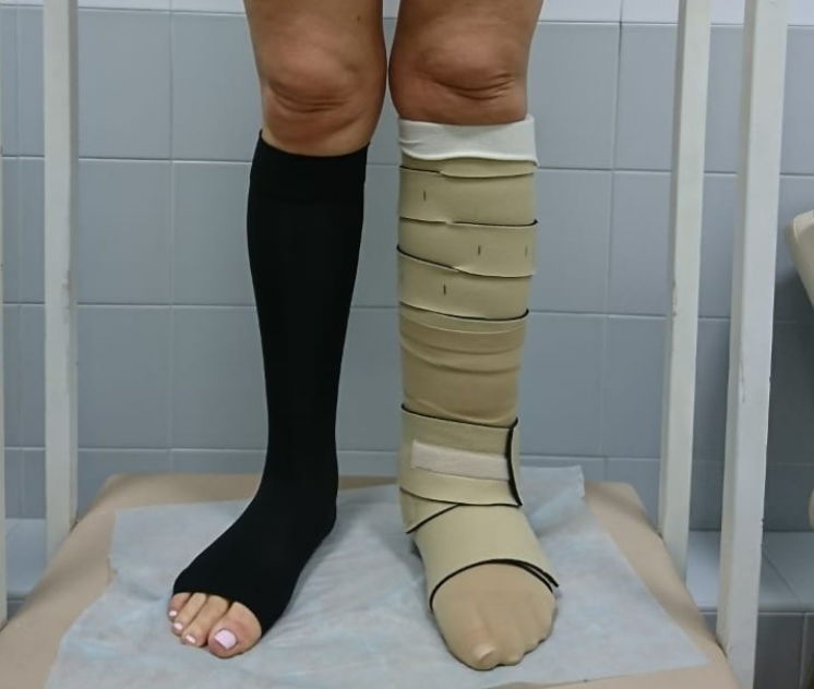 Нерастяжимый компрессионный бандаж Циркейд позволяет уменьшить отек в домашних условиях.