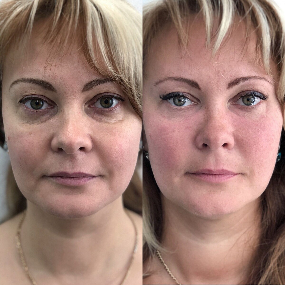 На фото до и после коррекции носослезной борозды. Источник фото яндекс картинки