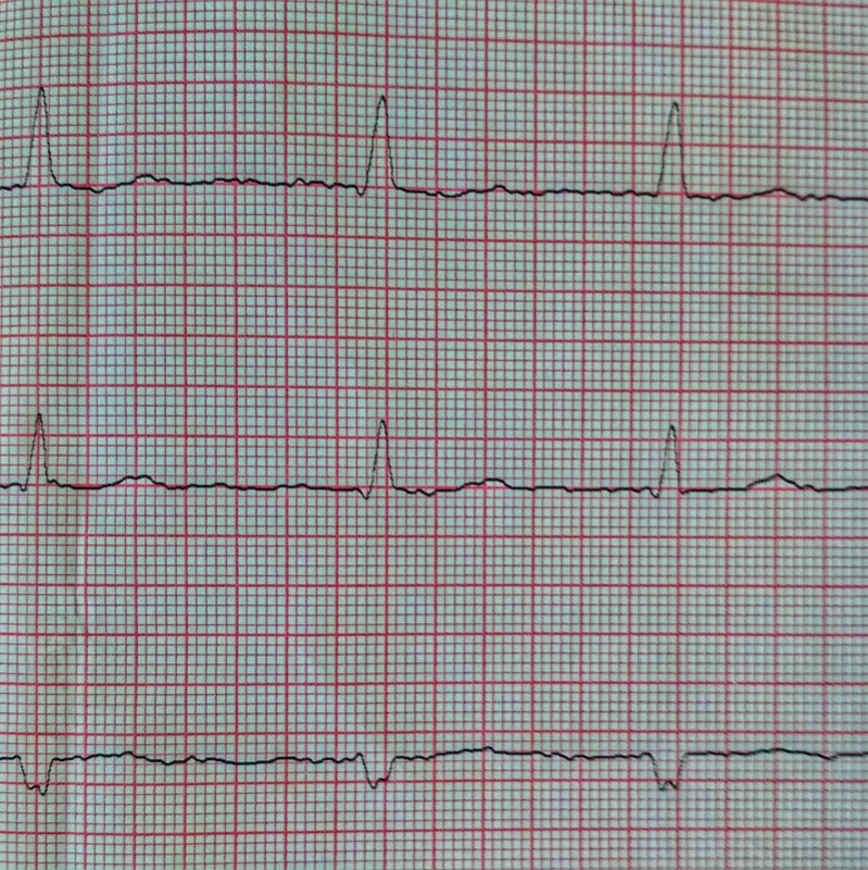 Аритмия на экг фото