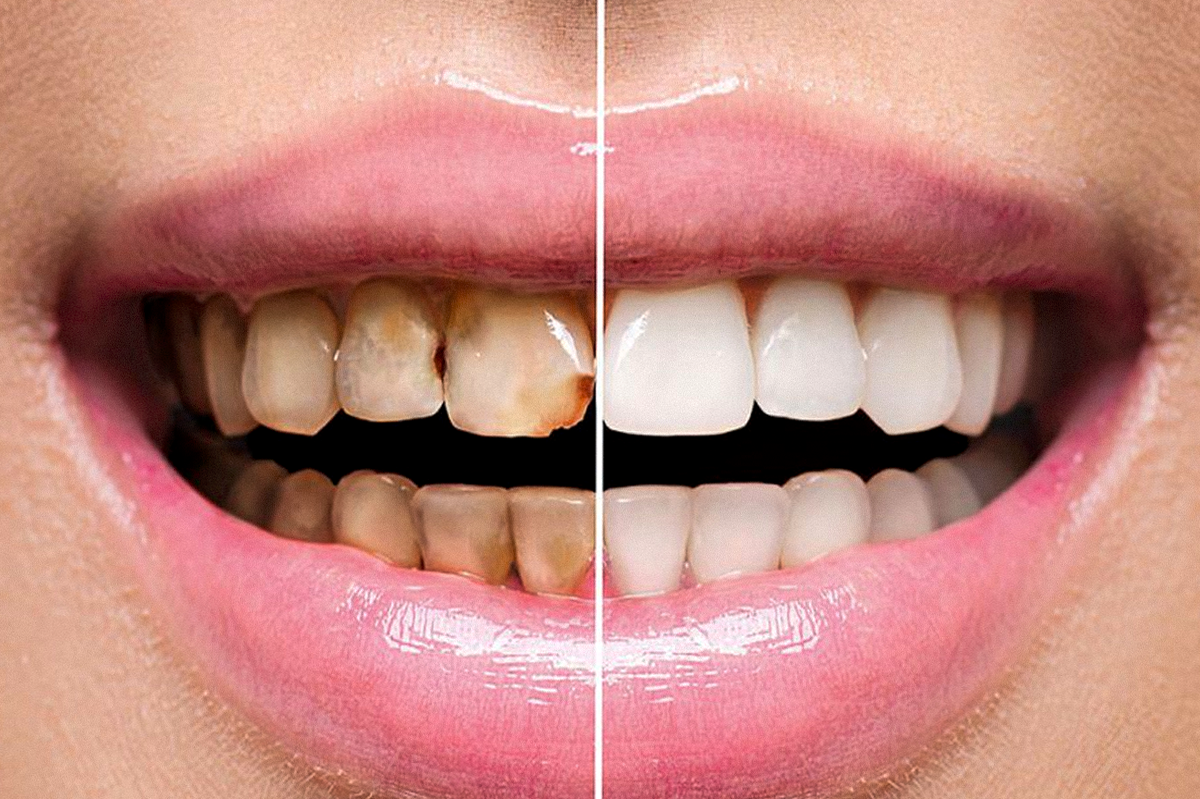 Последствия злоупотребления сахаром.