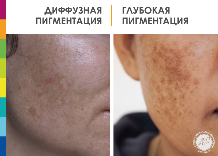 Переход от диффузной к стойкой и глубокой пигментации может сатать незаметным для вас. Результат - от пятен становится значительно труднее избавиться!