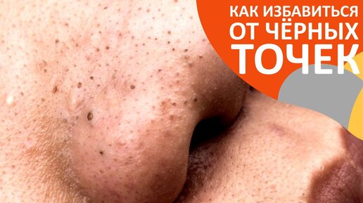 Как избавиться от чёрных точек | Что такое чёрные точки | От чего зависит появление чёрных точек