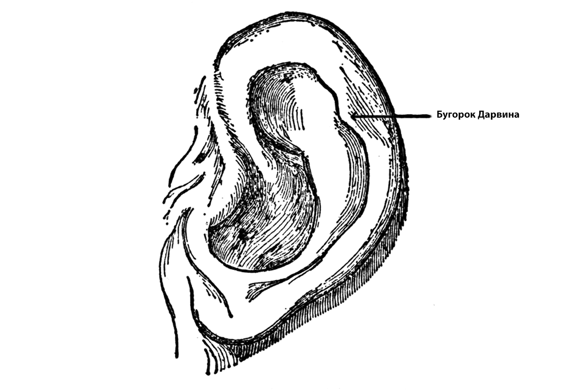 Бугорок дарвина на ухе фото