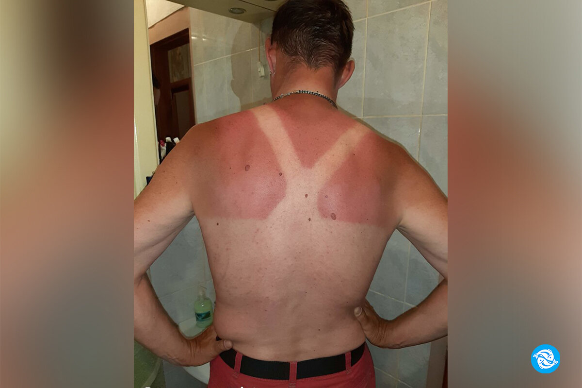 Фото автора. Реально думал, что пару часов ловли голавля взабродку на жаре пройдут бесследно. Однако след остался...