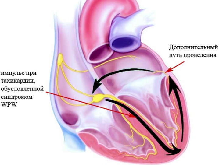 Паркинсон сердца. ВПВ синдром. Wpw-синдром (Вольфа-Паркинсон-Уайта) характеризуется признаками:. Синдром Wolff - Parkinson - White. Синдром wpw сердца что это.