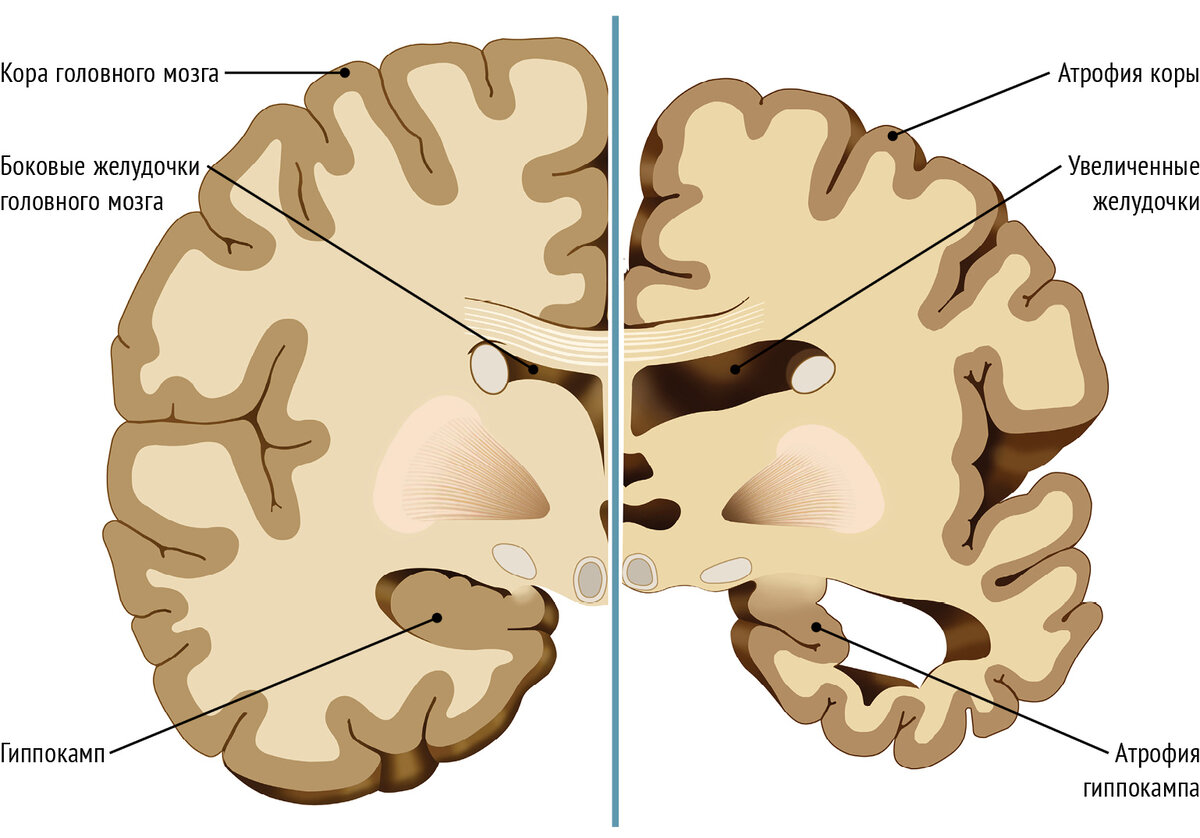 Изменения в головном мозге. Мозг больного Альцгеймером. Асимметрия желудочков мозга. Головной мозг при шизофрении.