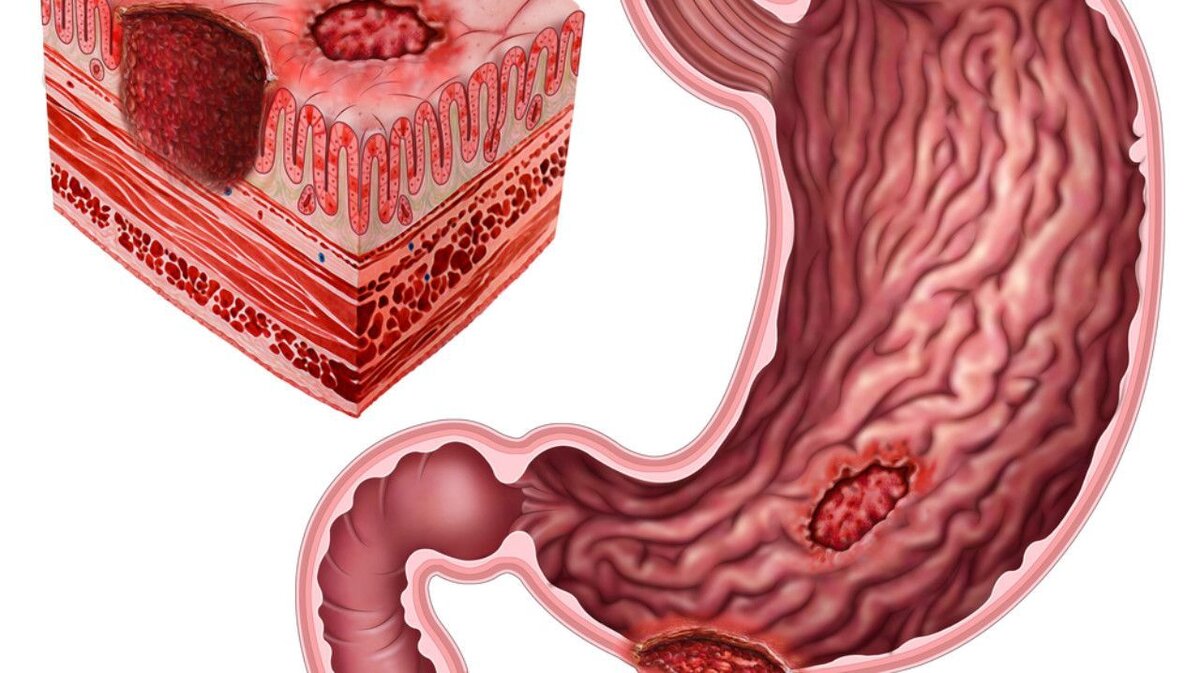 Язва желудка