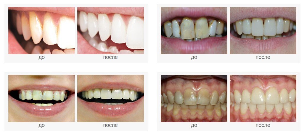 Полировка и шлифовка зубов: цены в стоматологии, особенности процедуры — ROOTT