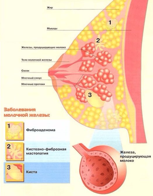 Доброкачественные опухоли молочной железы