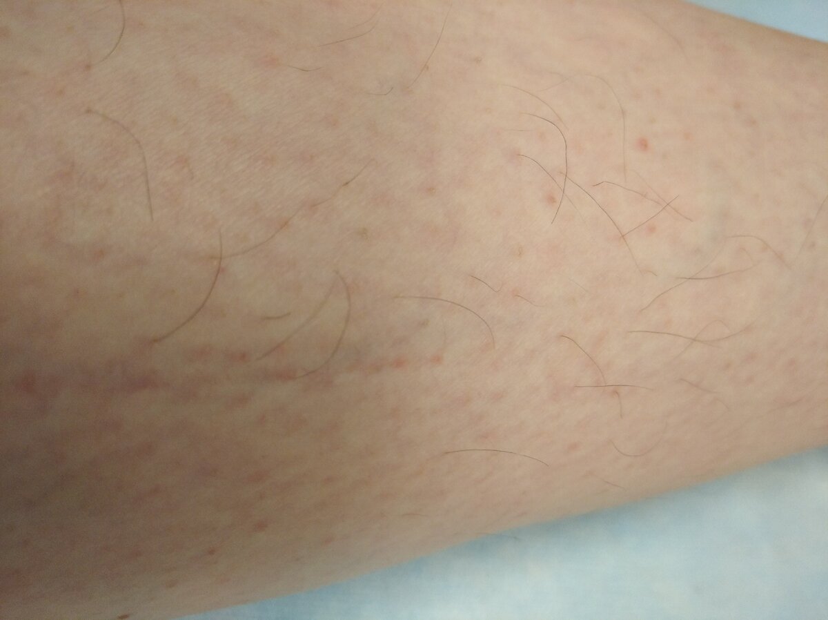 Вот с этим я и желала расстаться. И хорошо, что у меня нет варикоза. Иначе бы мне отказали в процедуре. 