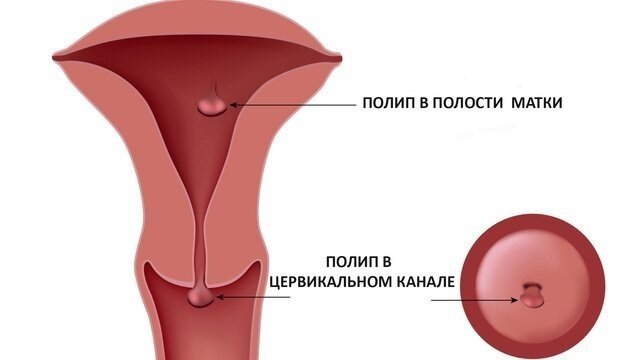 Полипы.