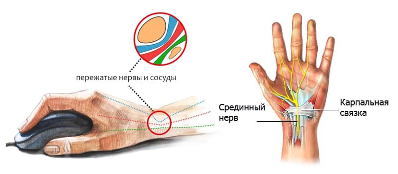 Программа CheckUp «Боль и онемение в руках»