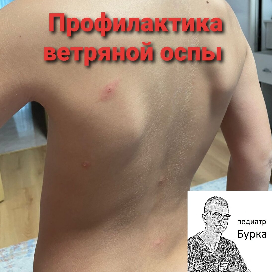 Сыпь при лёгком течении ветряной оспы 