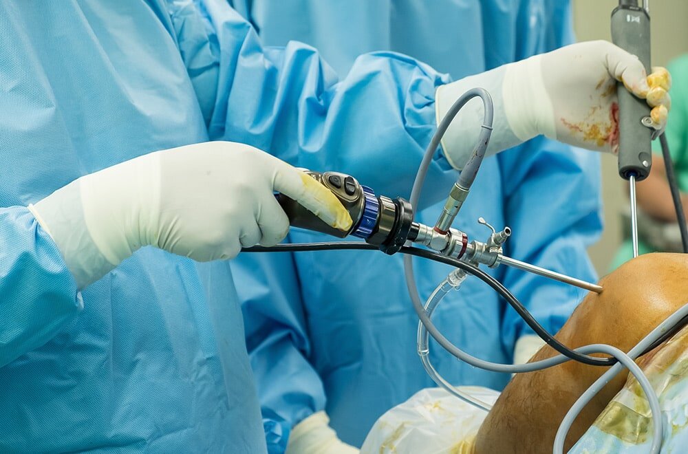 Артроскопия коленного состава - самый современный и эффективный способ хирургического лечения менисков. Контролировать ход проведения операции хирургу помогает специальная видеокамера - артроскоп.