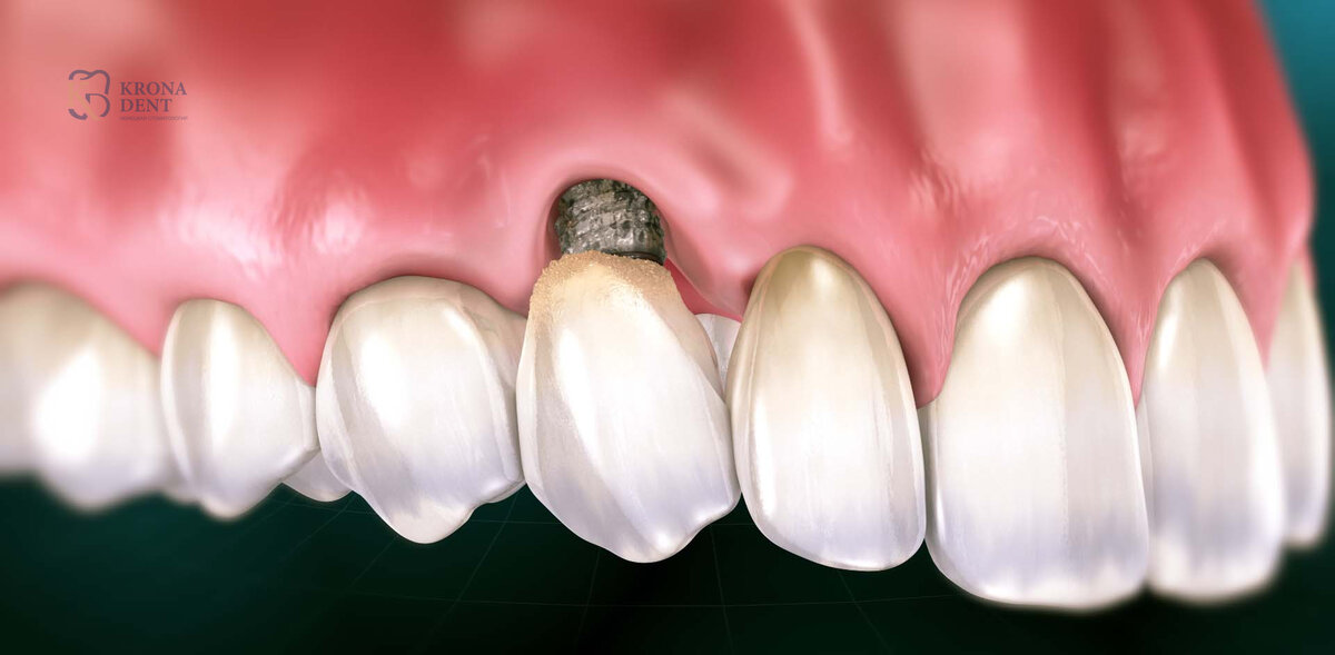 Отторжение импланта зуба фото Имплантат зуба не прижился. Почему это может случиться и что делать? Крона Дент 