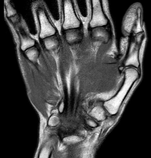 МРТ лучезапястного сустава 