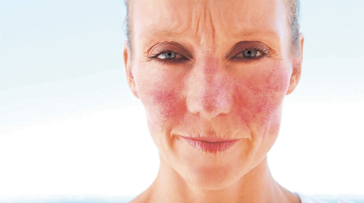 Все о розацеа