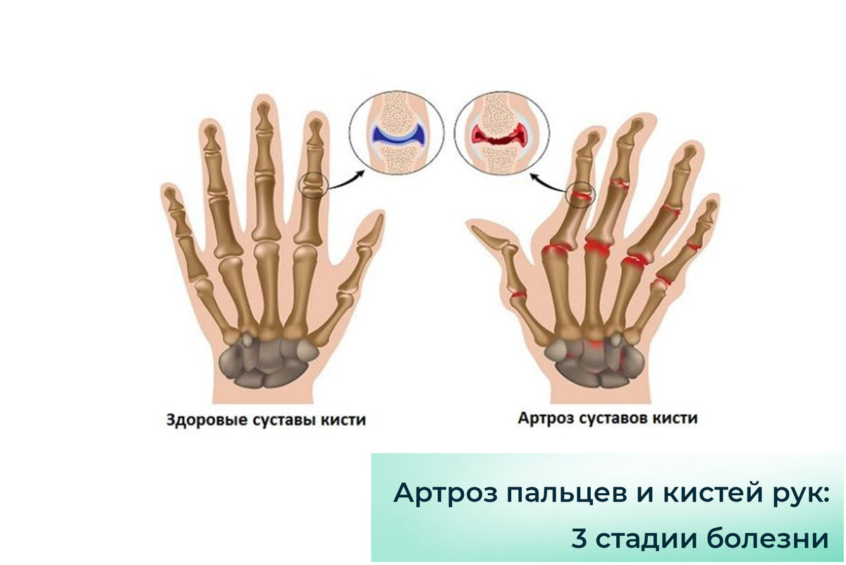 Лечение артроза кистей рук